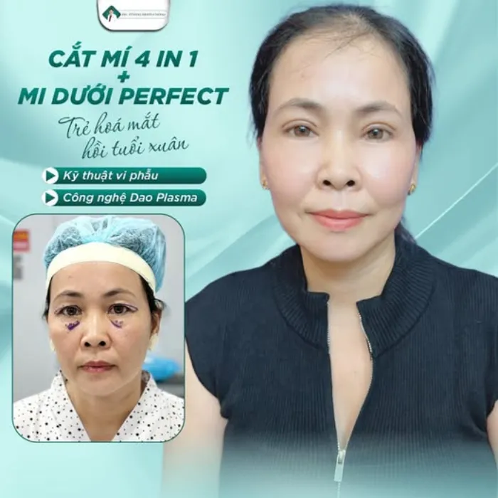 Có nên cắt mí giá rẻ​? Ưu nhược điểm, lưu ý khi cắt mí an toàn