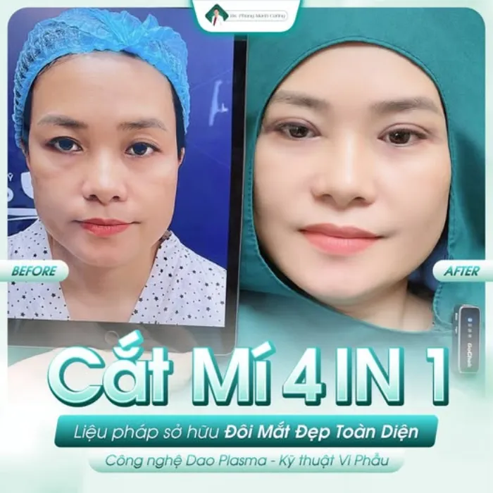 Có nên cắt mí giá rẻ​? Ưu nhược điểm, lưu ý khi cắt mí an toàn