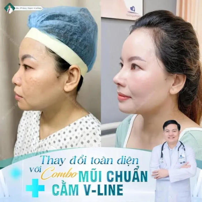 Giải Mã Xu Hướng Gọt Cằm V-line: Đẹp Tự Nhiên, An Toàn Tối Đa