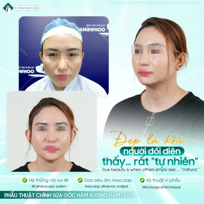 Gọt hàm nghỉ dưỡng bao lâu?