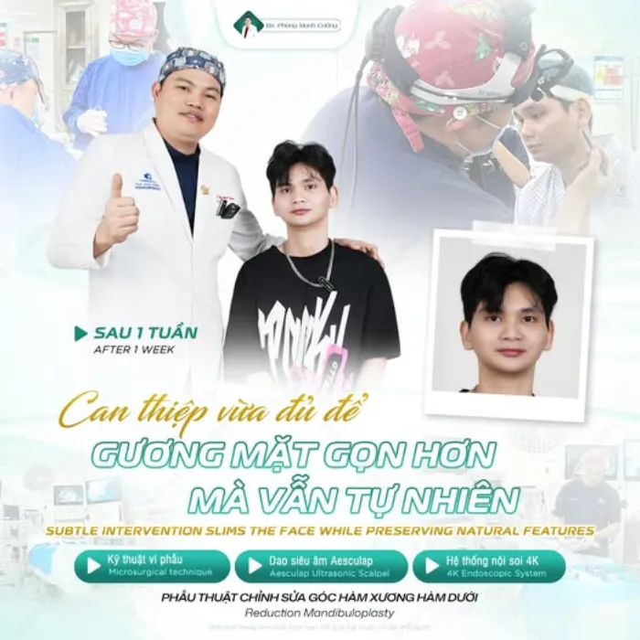 Gọt hàm nghỉ dưỡng bao lâu?