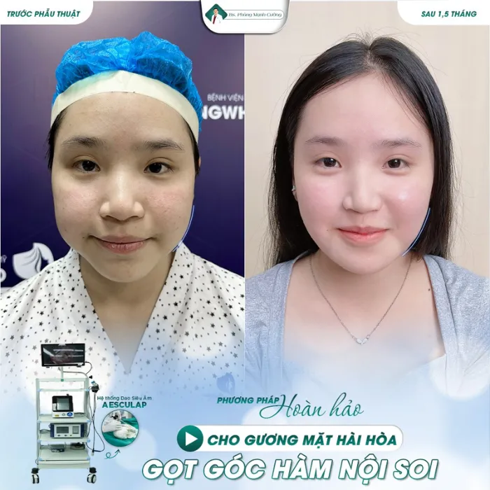 Gọt hàm nghỉ dưỡng bao lâu?