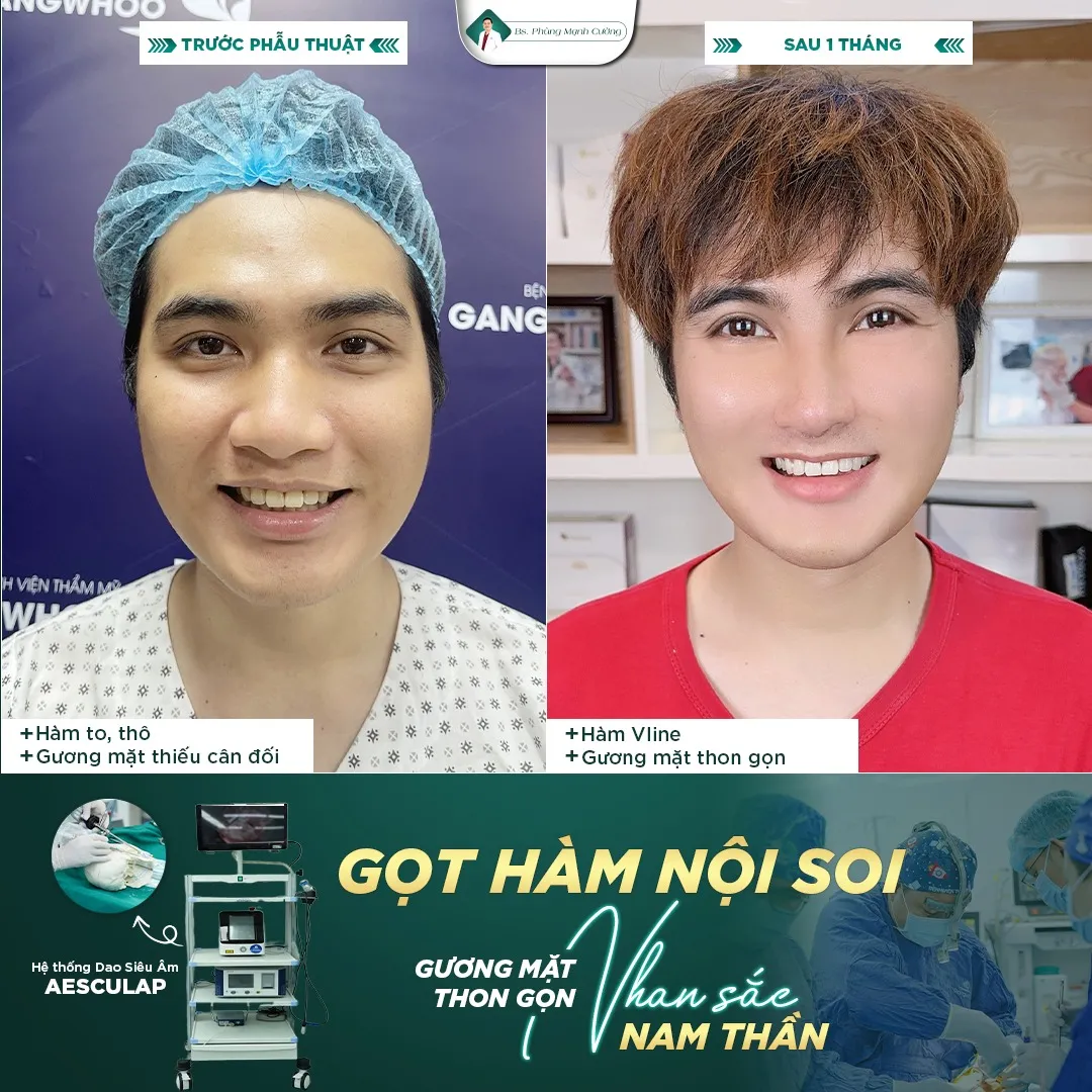 Hình Ảnh, Video Khách Hang Gọt Mặt Tại Bs Phùng Mạnh Cường