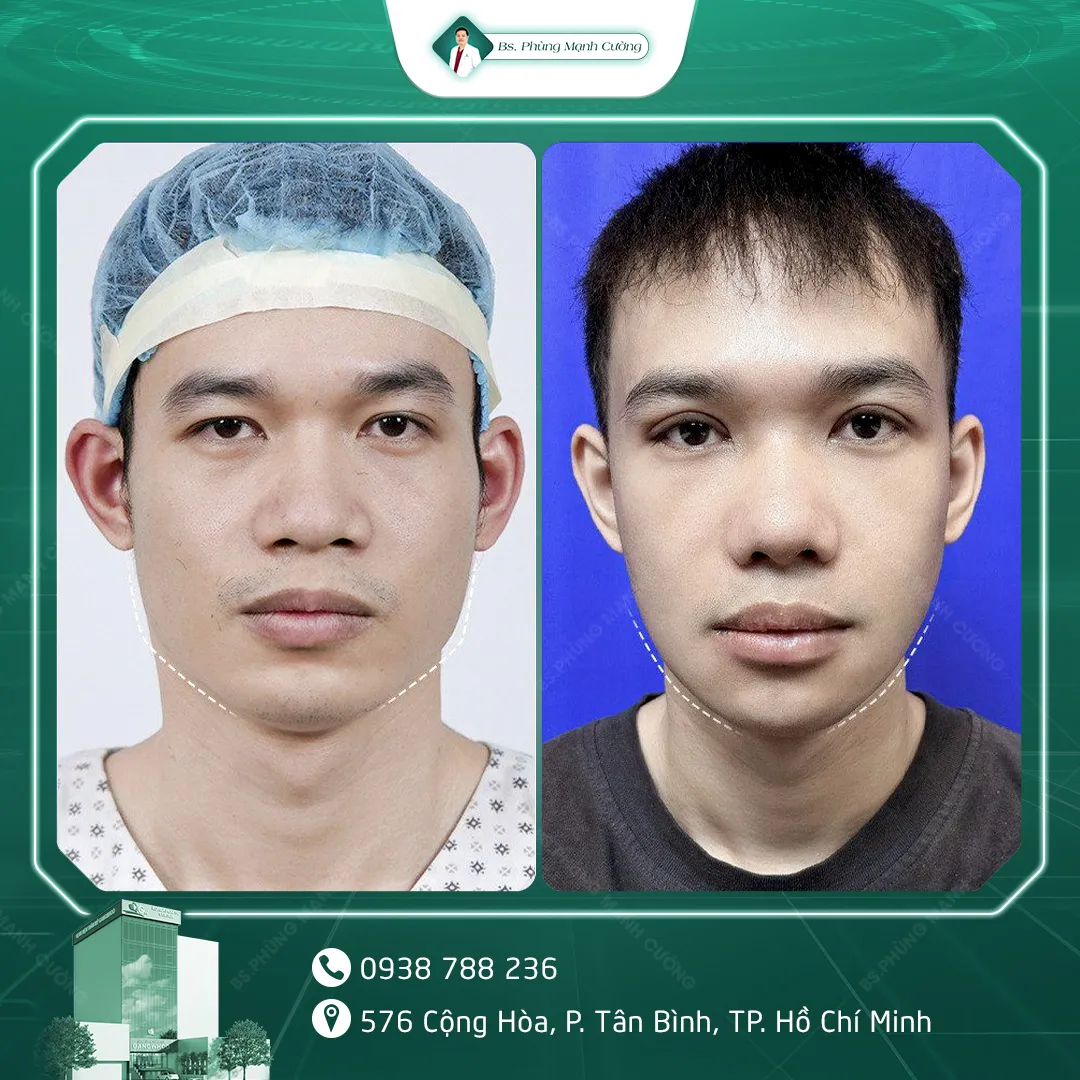 Hình Ảnh, Video Khách Hang Gọt Mặt Tại Bs Phùng Mạnh Cường