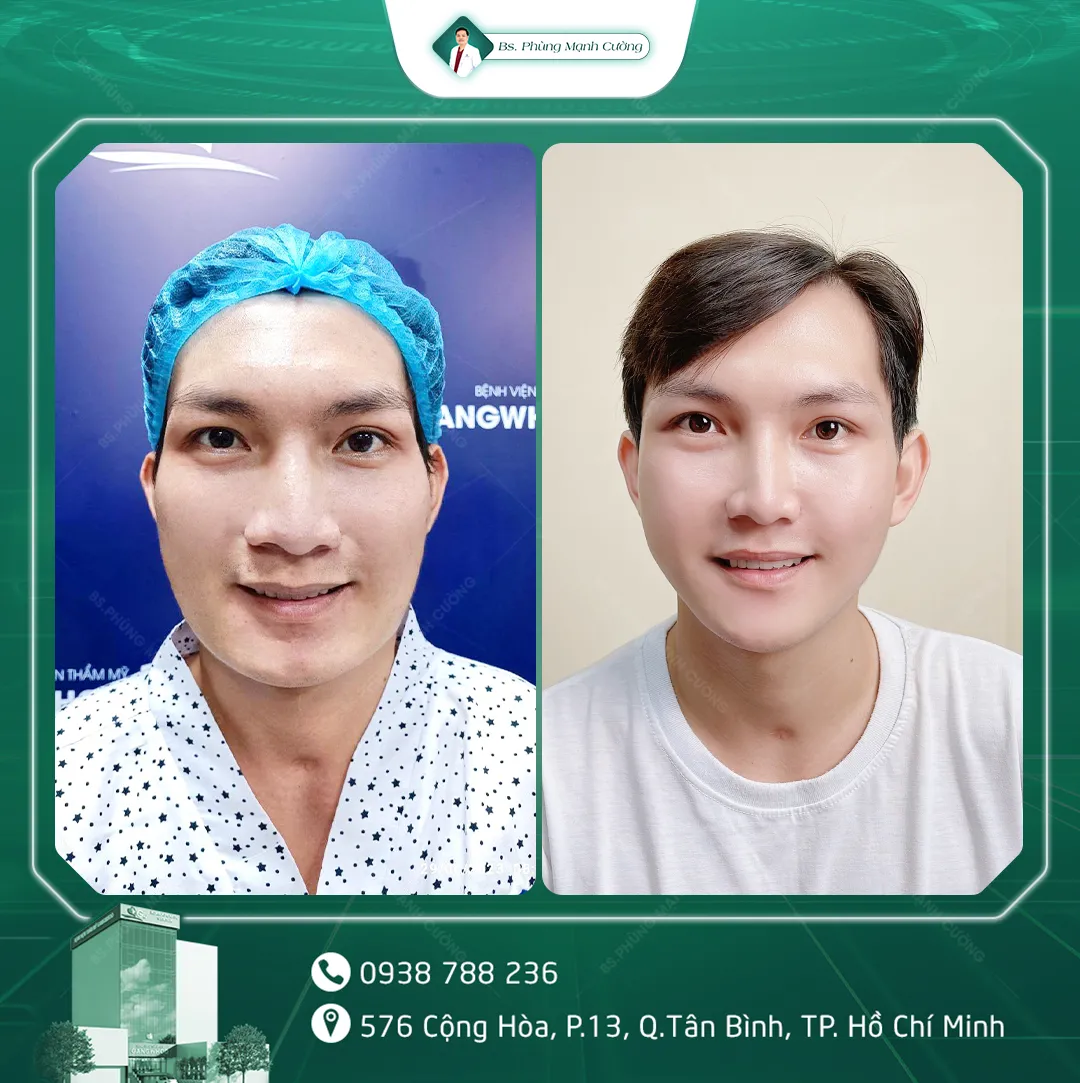 Hình Ảnh, Video Khách Hang Gọt Mặt Tại Bs Phùng Mạnh Cường