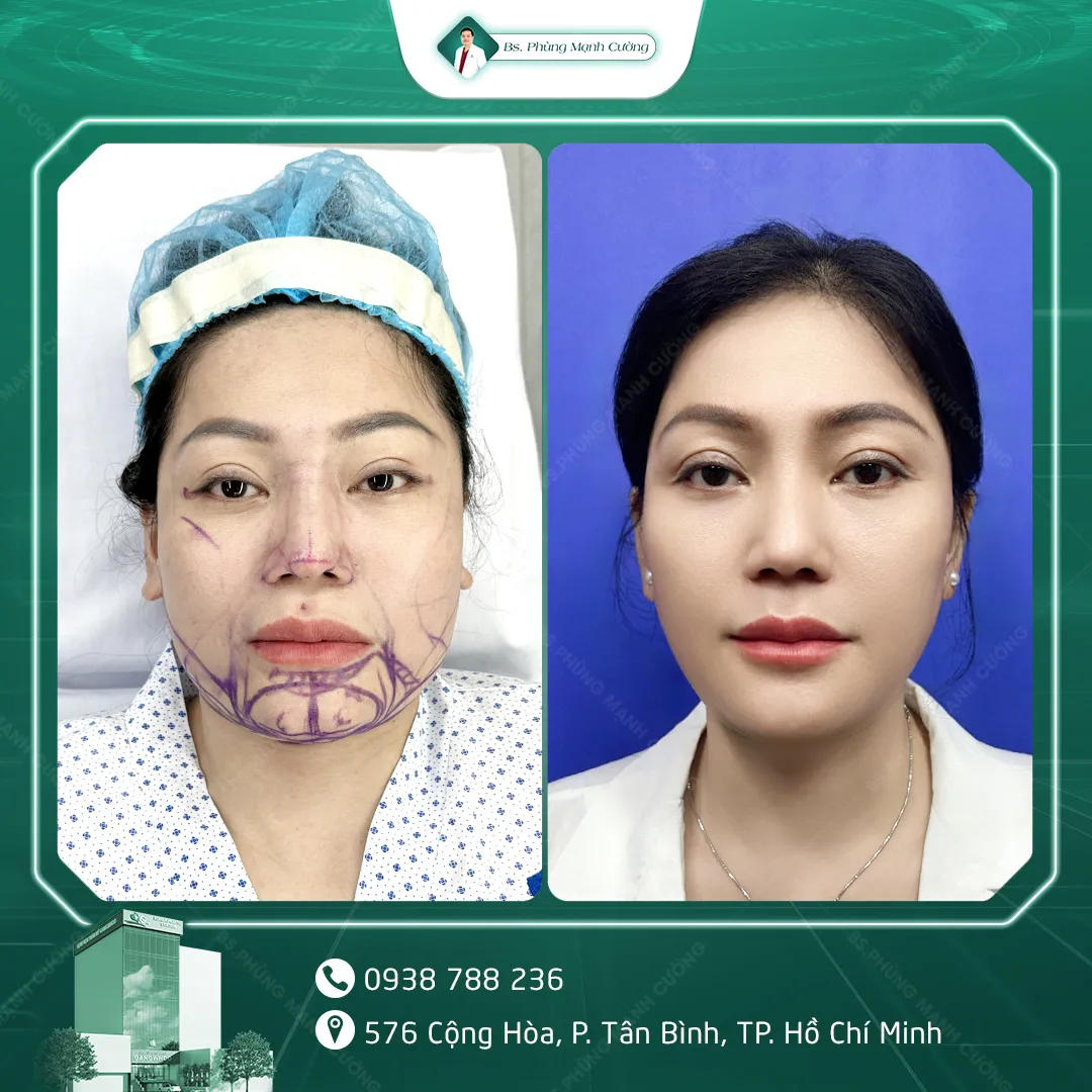 Hình Ảnh, Video Khách Hang Gọt Mặt Tại Bs Phùng Mạnh Cường