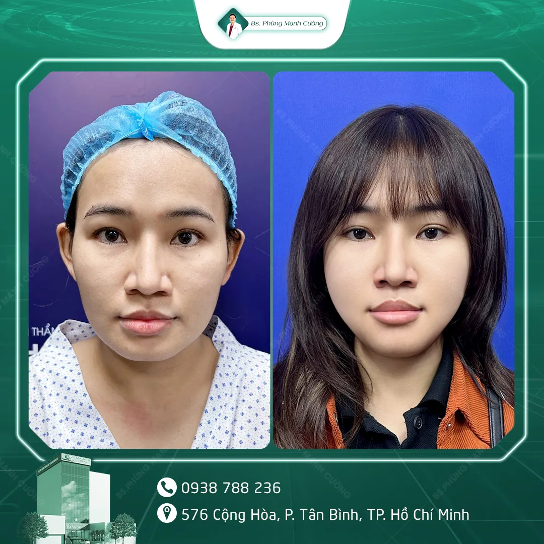 Hình Ảnh, Video Khách Hang Gọt Mặt Tại Bs Phùng Mạnh Cường