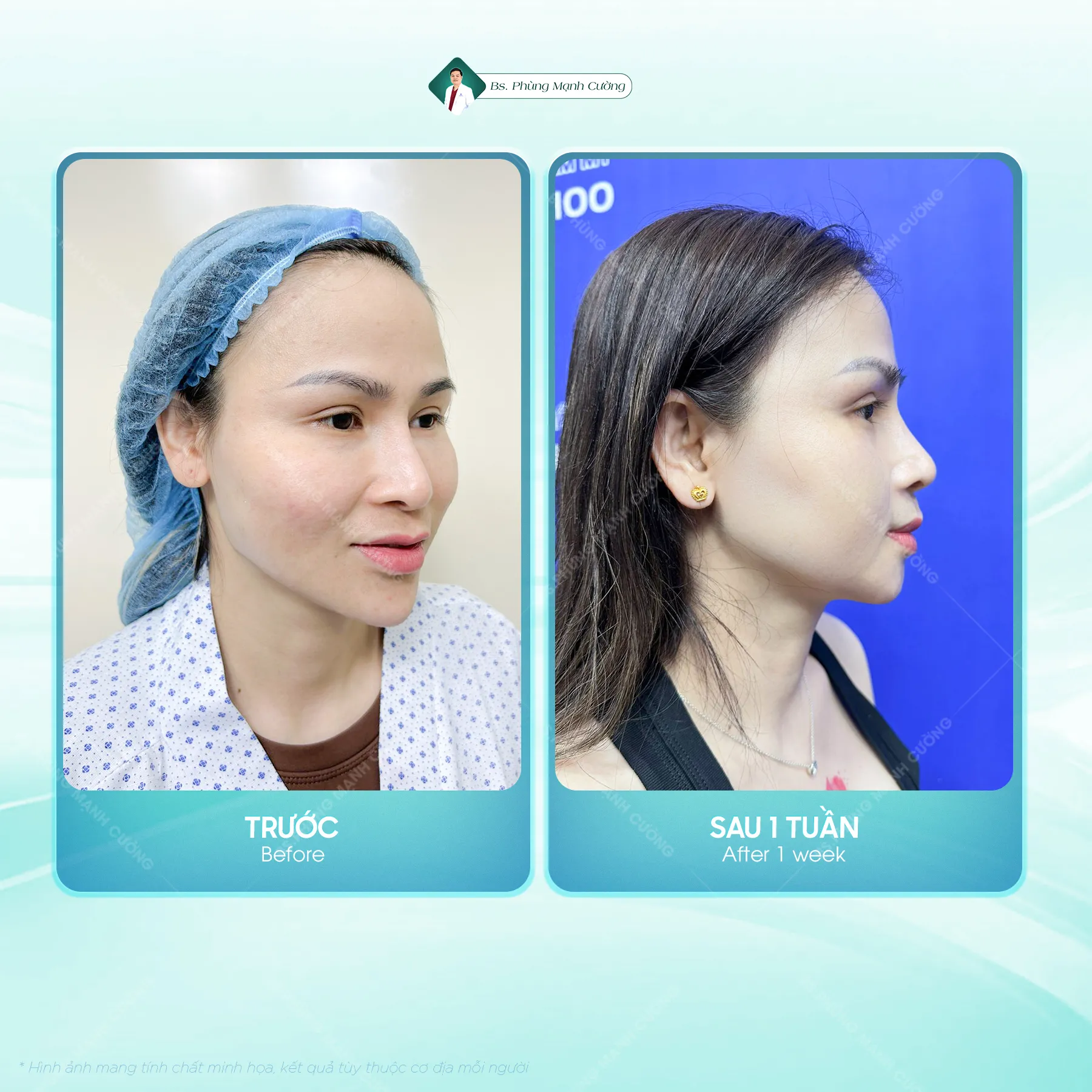 Hình Ảnh, Video Khách Hang Gọt Mặt Tại Bs Phùng Mạnh Cường