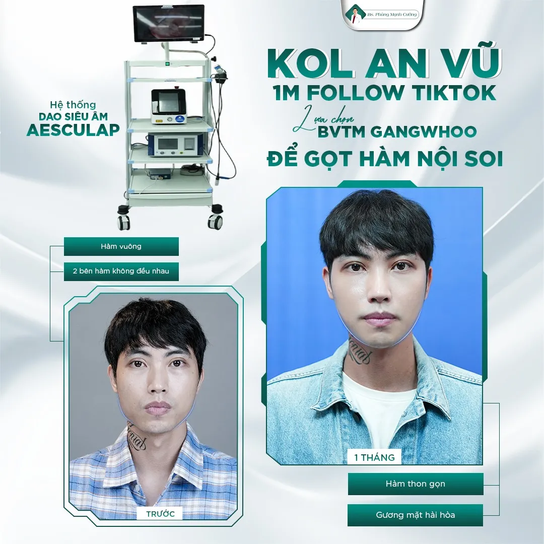 Hình Ảnh, Video Khách Hang Gọt Mặt Tại Bs Phùng Mạnh Cường