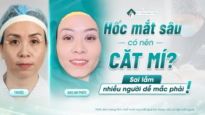 Hốc mắt sâu có nên cắt mí? Sai lầm nhiều người dễ mắc phải