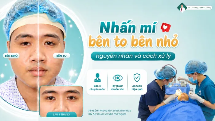 Nhấn mí bên to bên nhỏ nguyên nhân và cách xử lý