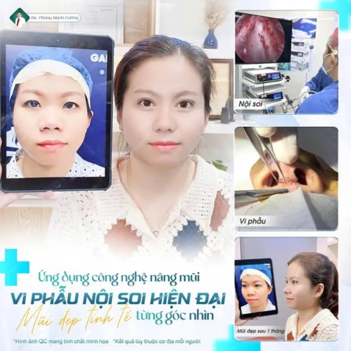 Mũi Lân Là Gì? Đặc Điểm, Ý Nghĩa Tướng Số Và Cách Cải Thiện Thẩm Mỹ