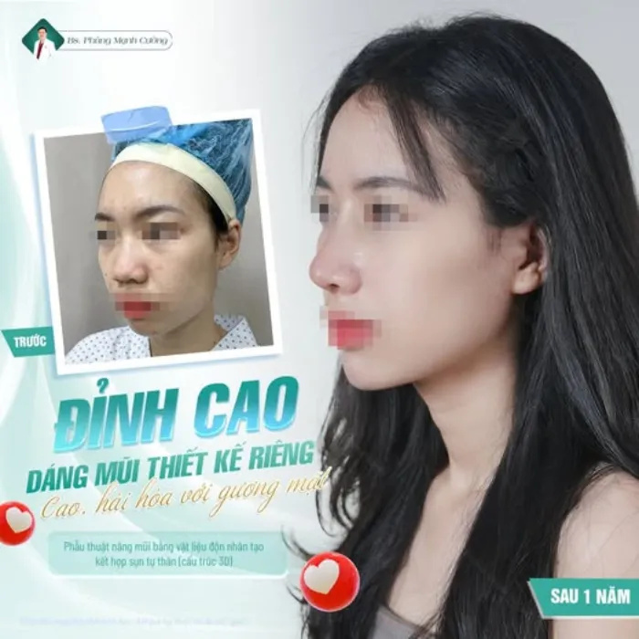 Mũi Lân Là Gì? Đặc Điểm, Ý Nghĩa Tướng Số Và Cách Cải Thiện Thẩm Mỹ