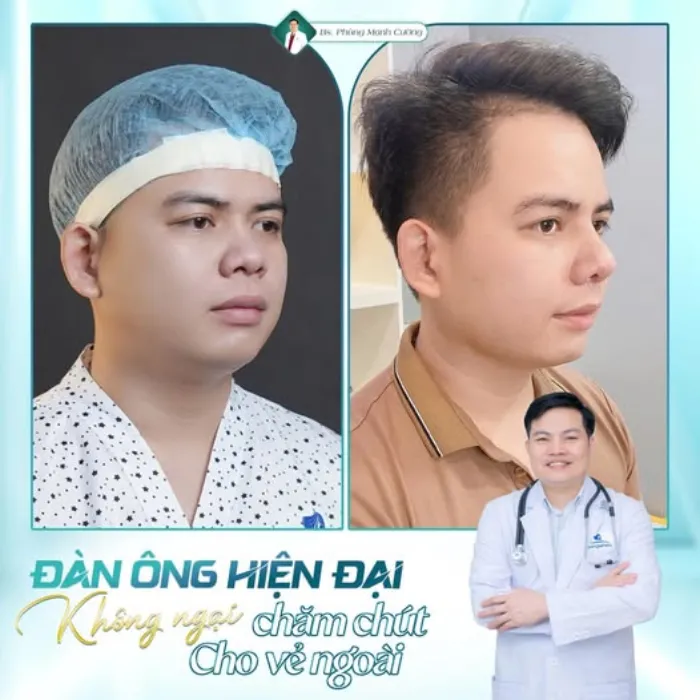 Mũi Lân Là Gì? Đặc Điểm, Ý Nghĩa Tướng Số Và Cách Cải Thiện Thẩm Mỹ