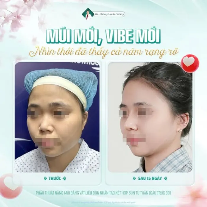 Mũi Lân Là Gì? Đặc Điểm, Ý Nghĩa Tướng Số Và Cách Cải Thiện Thẩm Mỹ