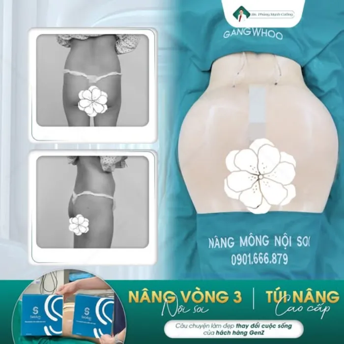 Nâng Mông Sebbin: Bí Quyết Sở Hữu Vòng 3 Hoàn Hảo Tại Bác Sĩ Phùng Mạnh Cường