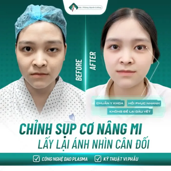 Nhấn mí bên to bên nhỏ