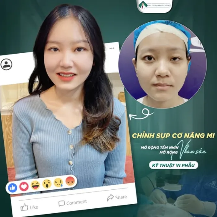 Nhấn mí bên to bên nhỏ