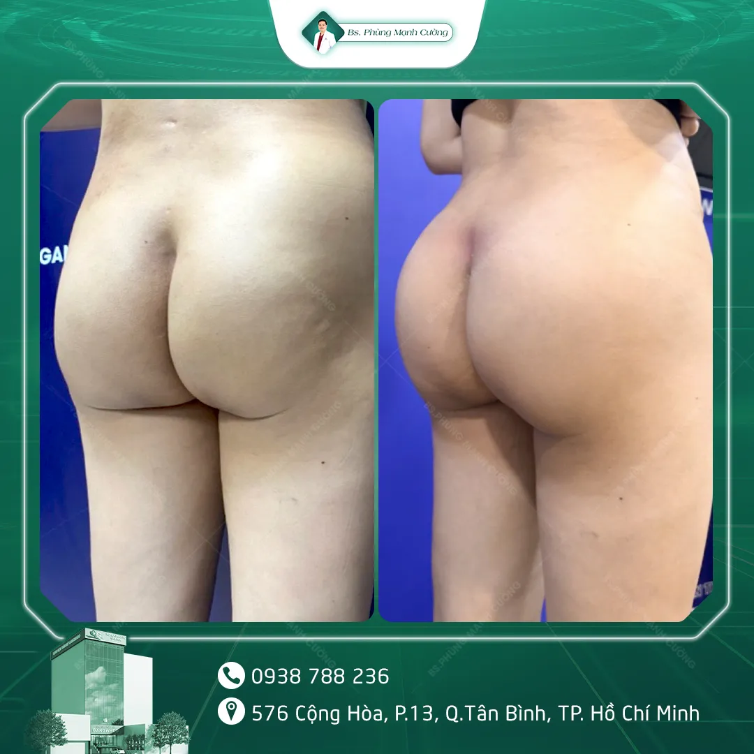 Hình Ảnh, Video Khách Hàng Thẩm Mỹ Vòng 3 Tại Bs Phùng Mạnh Cường