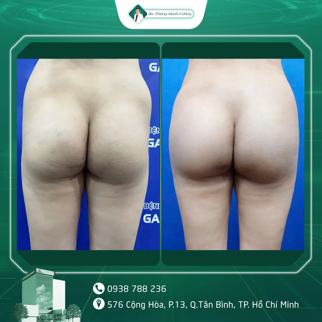 Hình Ảnh, Video Khách Hàng Thẩm Mỹ Vòng 3 Tại Bs Phùng Mạnh Cường