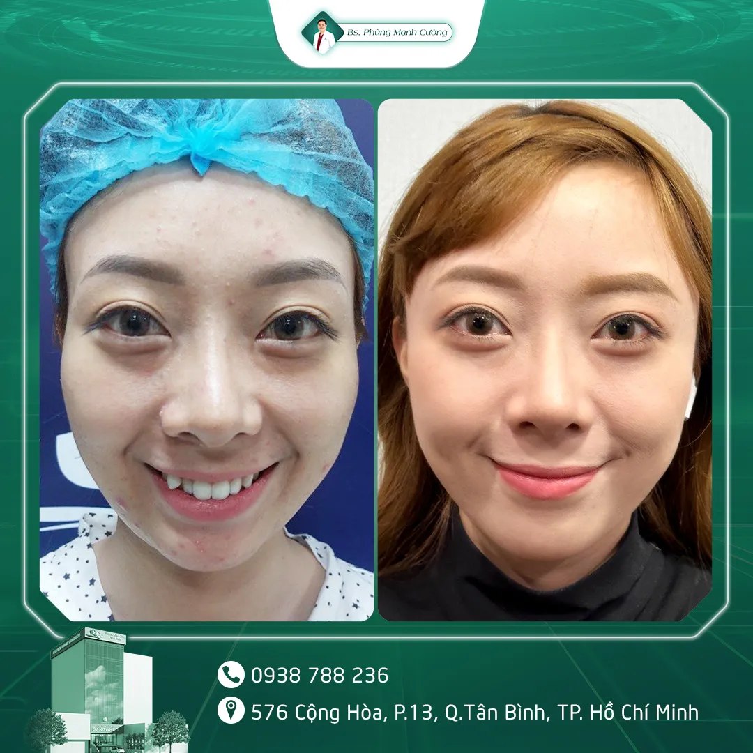 Hình Ảnh, Video Khách Hàng Độn Thái Dương Tại Bs Phùng Mạnh Cường