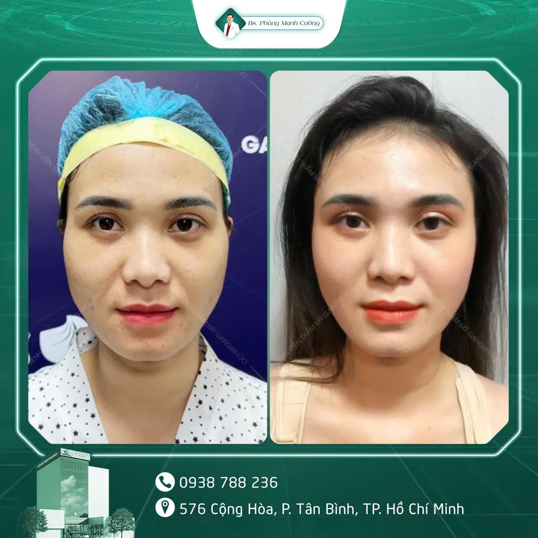 Hình Ảnh, Video Khách Hàng Độn Thái Dương Tại Bs Phùng Mạnh Cường