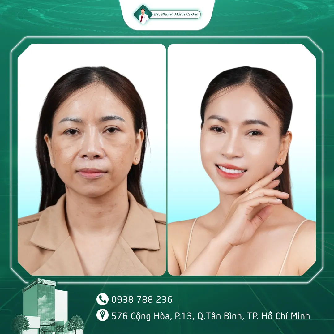Hình Ảnh, Video Khách Hàng Điều Trị Da Tại Bs Phùng Mạnh Cường
