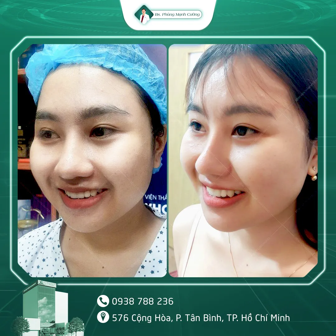 Hình Ảnh, Video Khách Hàng Lấy Túi Mỡ Má Tại BS Phùng Mạnh Cường