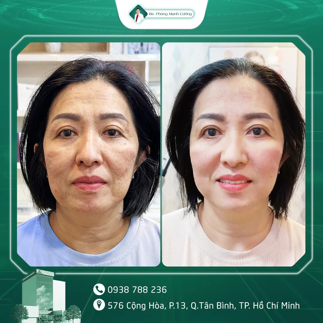 Hình Ảnh, Video Khách Hàng Điều Trị Da Tại Bs Phùng Mạnh Cường