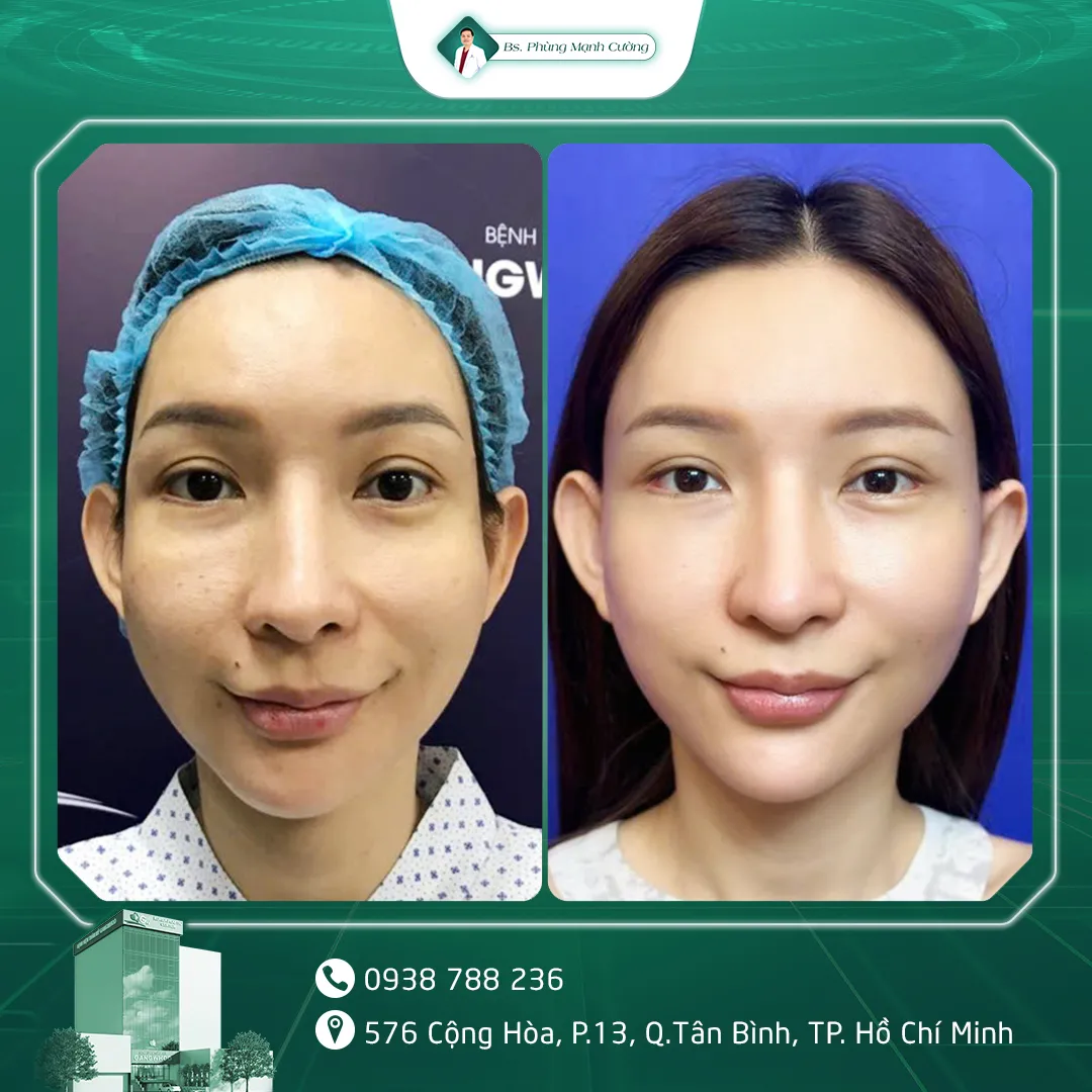 Hình Ảnh, Video Khách Hàng Độn Thái Dương Tại Bs Phùng Mạnh Cường