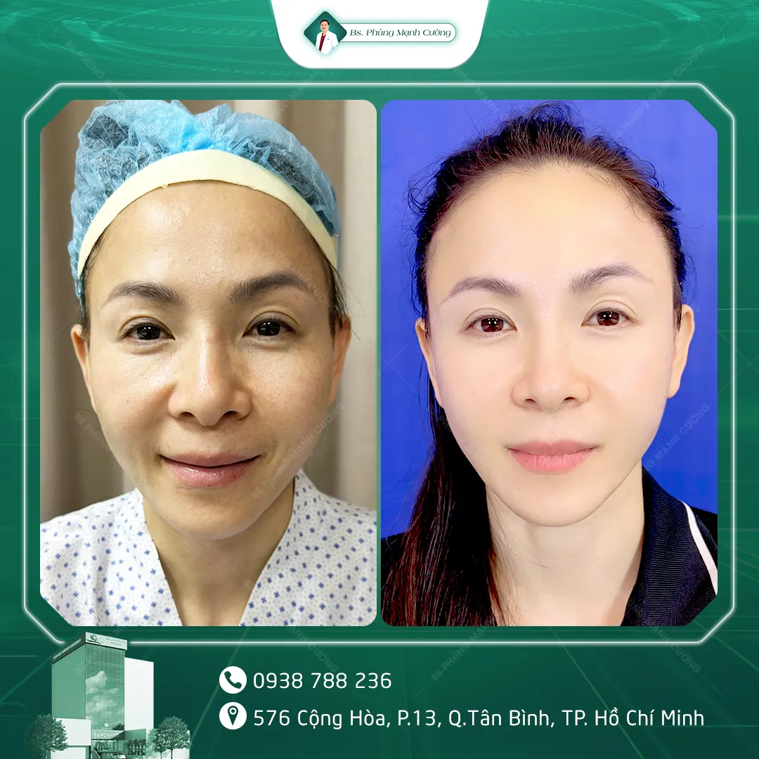 Hình Ảnh, Video Khách Hàng Độn Thái Dương Tại Bs Phùng Mạnh Cường