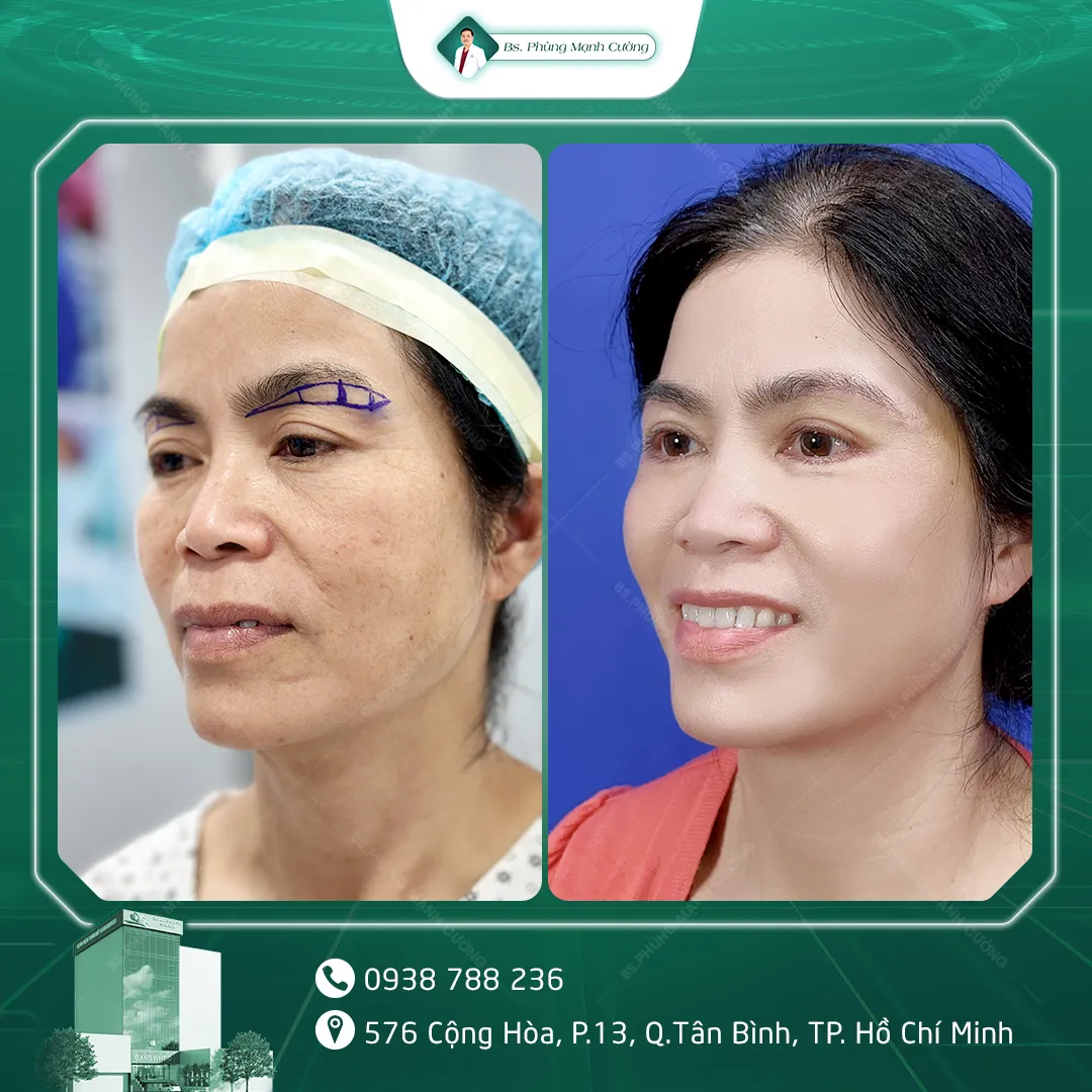 Hình Ảnh Khách Hàng Nâng Cung Chân Mày Tại BS Phùng Mạnh Cường