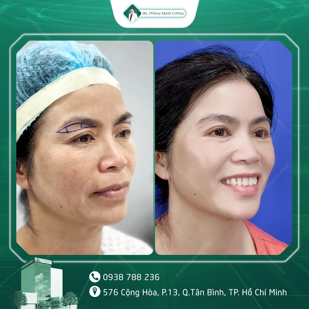 Hình Ảnh Khách Hàng Nâng Cung Chân Mày Tại BS Phùng Mạnh Cường