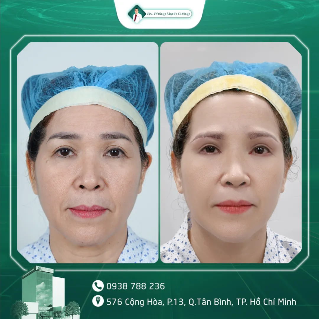Hình Ảnh Khách Hàng Nâng Cung Chân Mày Tại BS Phùng Mạnh Cường