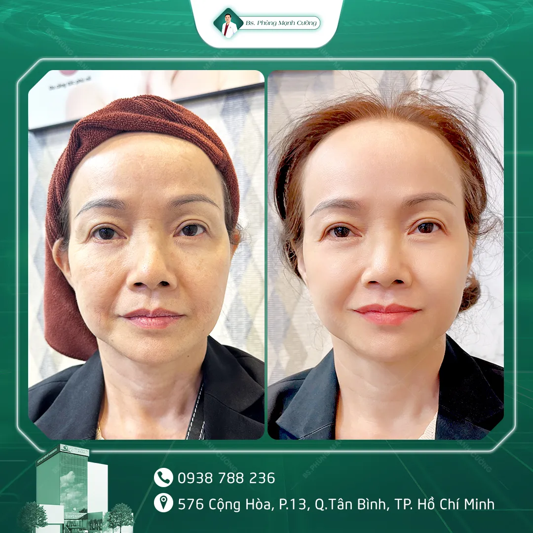 Hình Ảnh, Video Khách Hàng Điều Trị Da Tại Bs Phùng Mạnh Cường