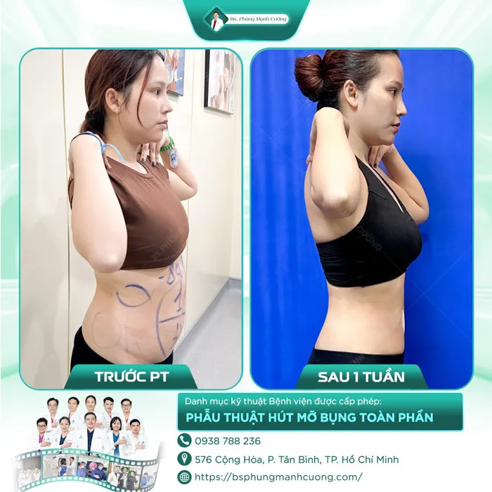 Giảm Mỡ Lipo Ultrasound Tiktok