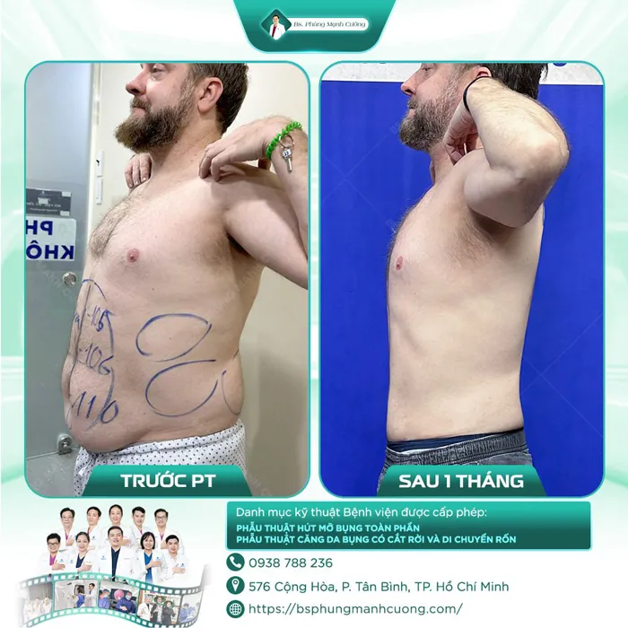 Giảm Mỡ Lipo Ultrasound Tiktok