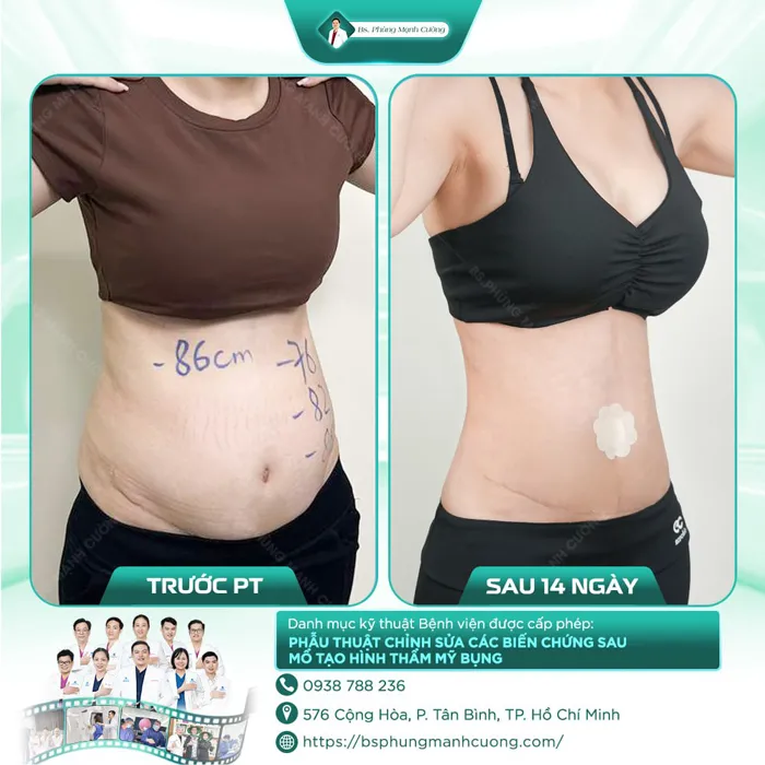 Giảm Mỡ Lipo Ultrasound Tiktok
