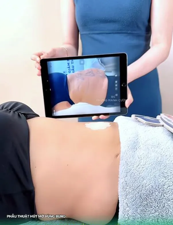 Giảm Mỡ Lipo Ultrasound