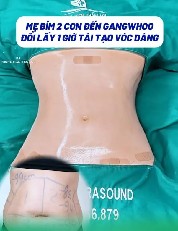 Giảm Mỡ Lipo Ultrasound