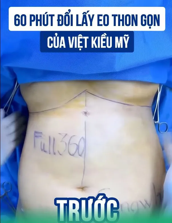 Giảm Mỡ Lipo Ultrasound