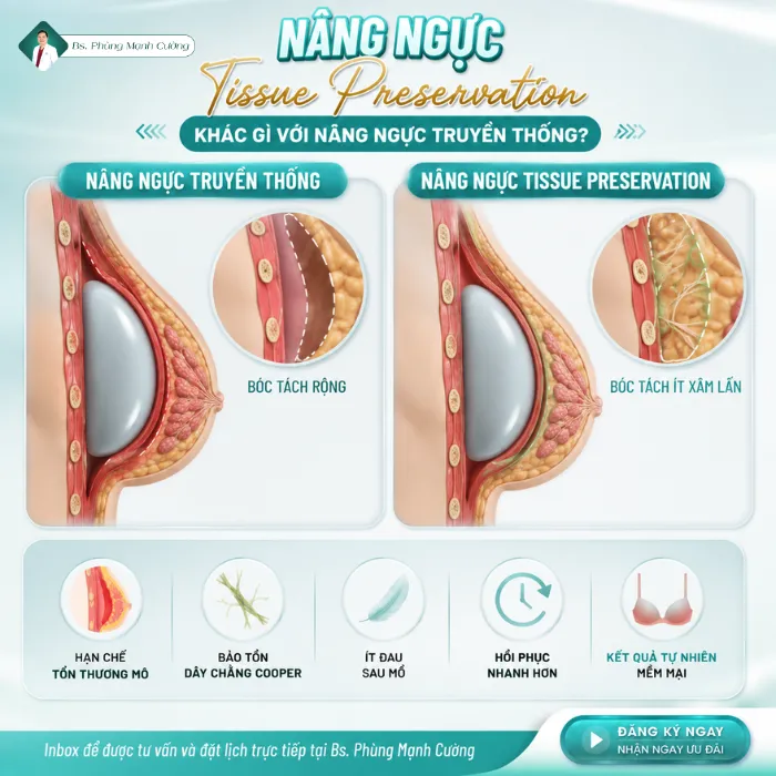 Nâng Ngực Tissue Preservation Là Gì? Kỹ Thuật Bảo Tồn Mô Hạn Chế Xâm Lấn 9 Nâng Ngực Tissue Preservation Là Gì? Kỹ Thuật Bảo Tồn Mô Hạn Chế Xâm Lấn