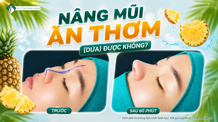Nâng Mũi Ăn Thơm (Dứa) Được Không? Bác Sĩ Cường Giải Đáp