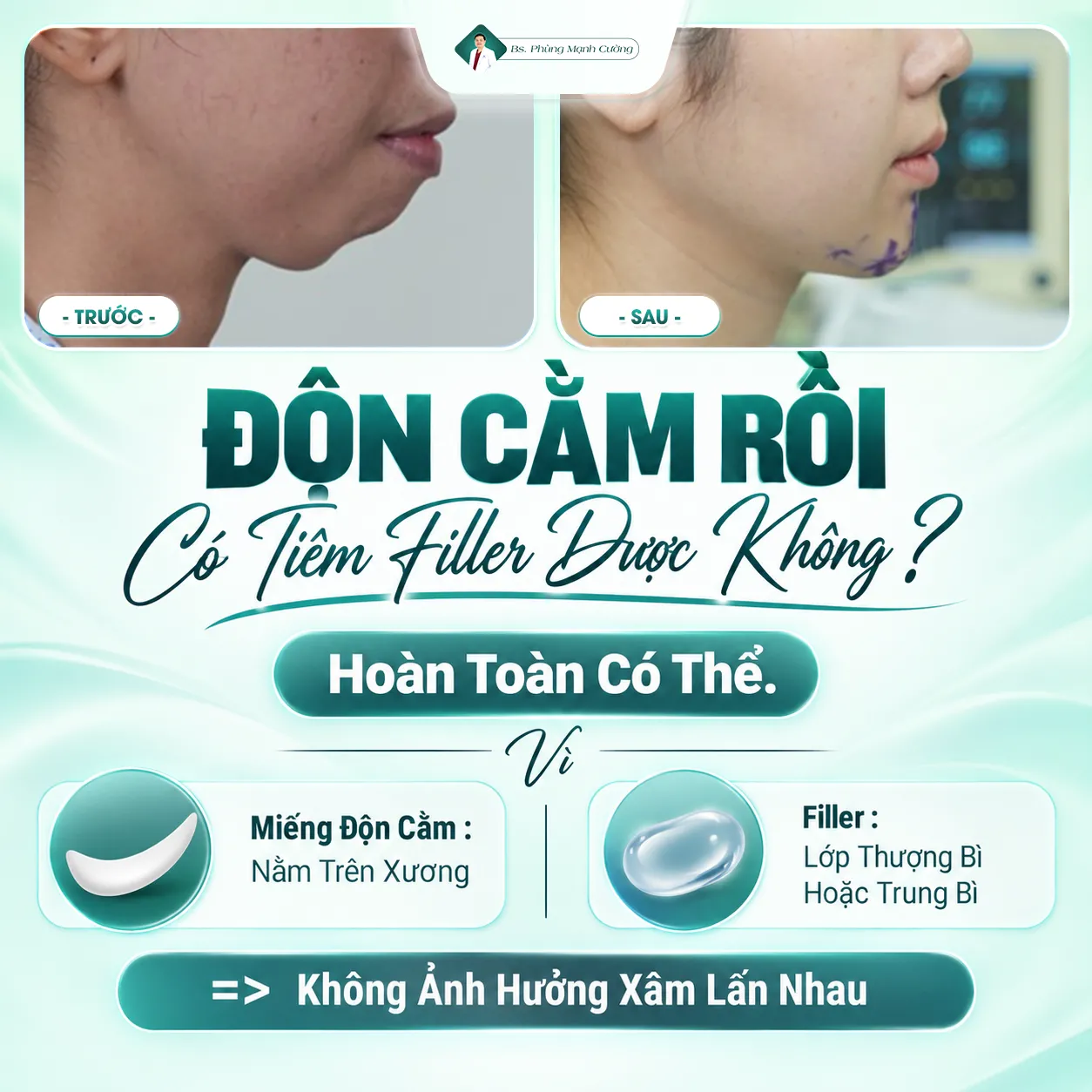 Độn Cằm Rồi Có Tiêm Filler Được Không?
