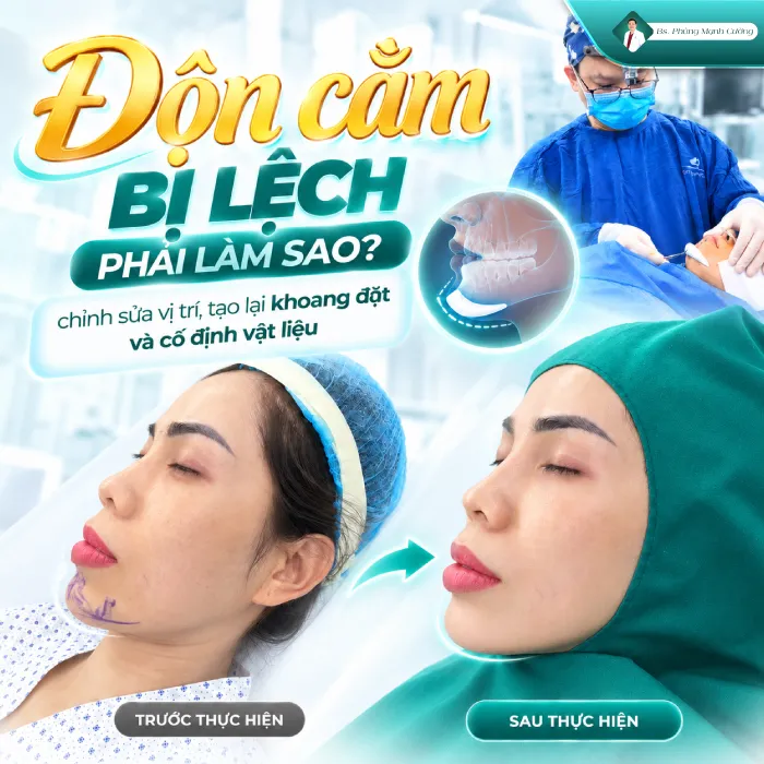 Độn Cằm Bị Lệch Phải Làm Sao? Nguyên Nhân Và Cách Khắc Phục