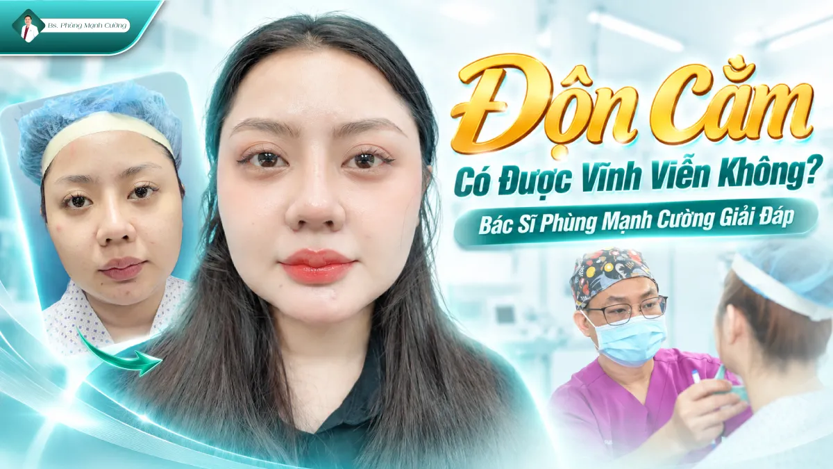 Độn Cằm Có Được Vĩnh Viễn Không? Bác Sĩ Phùng Mạnh Cường Giải Đáp