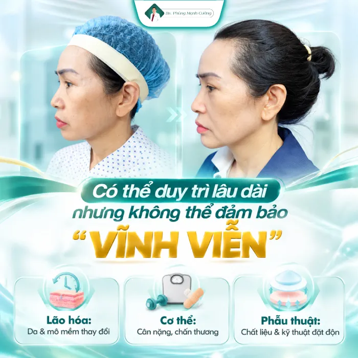 Độn Cằm Có Được Vĩnh Viễn Không? Bác Sĩ Phùng Mạnh Cường Giải Đáp 10 Độn Cằm Có Được Vĩnh Viễn Không? Bác Sĩ Phùng Mạnh Cường Giải Đáp