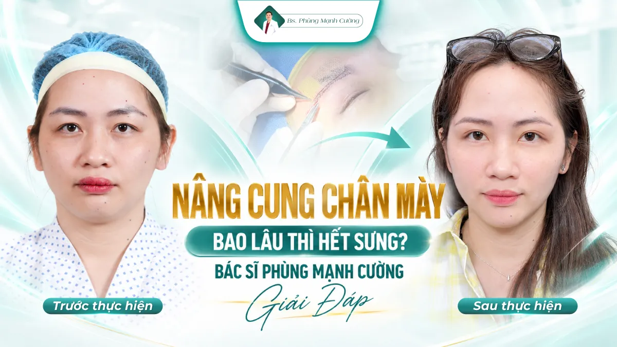 Nâng Cung Chân Mày Bao Lâu Thì Hết Sưng? Bác Sĩ Phùng Mạnh Cường Giải Đáp