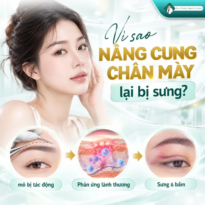 Nâng Cung Chân Mày Bao Lâu Thì Hết Sưng? Bác Sĩ Phùng Mạnh Cường Giải Đáp