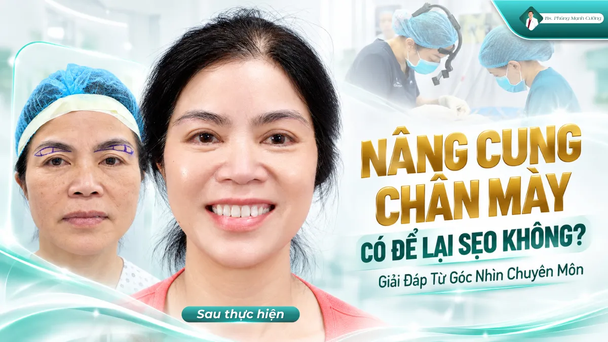 Nâng Cung Chân Mày Có Để Lại Sẹo Không? Giải Đáp Từ Góc Nhìn Chuyên Môn